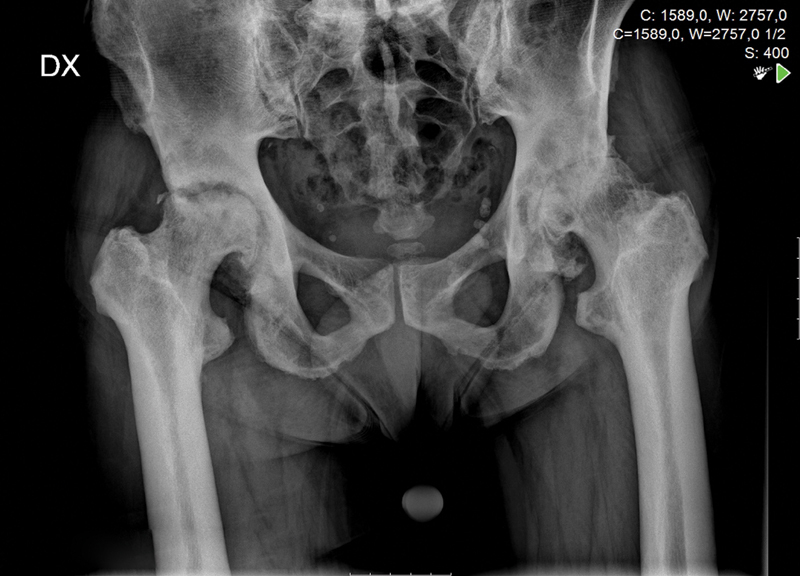 Bilateral Cemented Custom-Made Total Hip Arthroplasty in Paget's Disease with Femoral Cortical Thickening and Canal Narrowing.