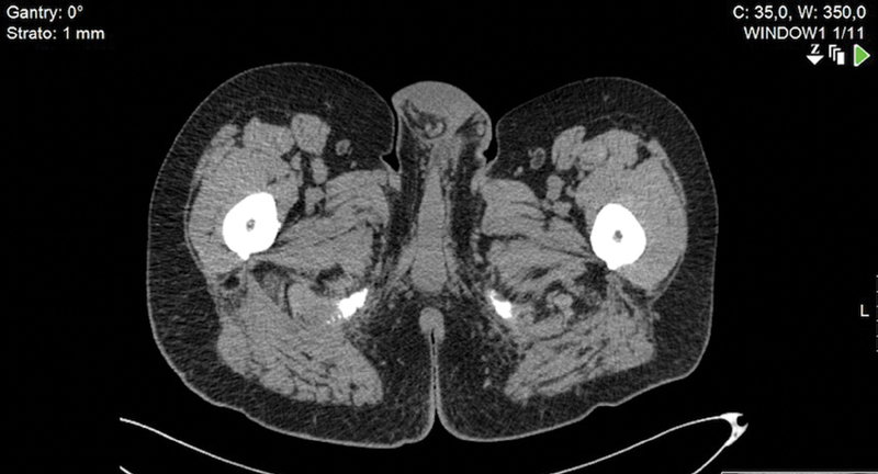 Bilateral Cemented Custom-Made Total Hip Arthroplasty in Paget's Disease with Femoral Cortical Thickening and Canal Narrowing.