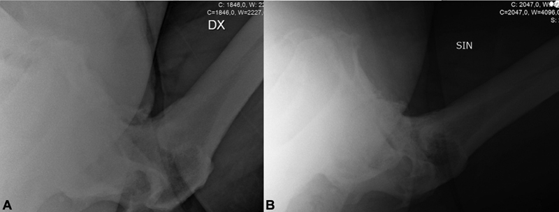 Bilateral Cemented Custom-Made Total Hip Arthroplasty in Paget's Disease with Femoral Cortical Thickening and Canal Narrowing.