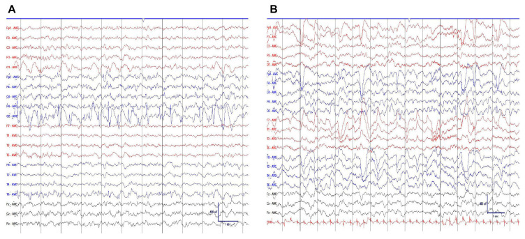 Pharmacoresistant Abdominal Seizures in Symptomatic Localization-Related Epilepsy.