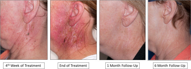 Proton Therapy for Major Salivary Gland Cancer: Clinical Outcomes.