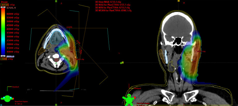 Proton Therapy for Major Salivary Gland Cancer: Clinical Outcomes.