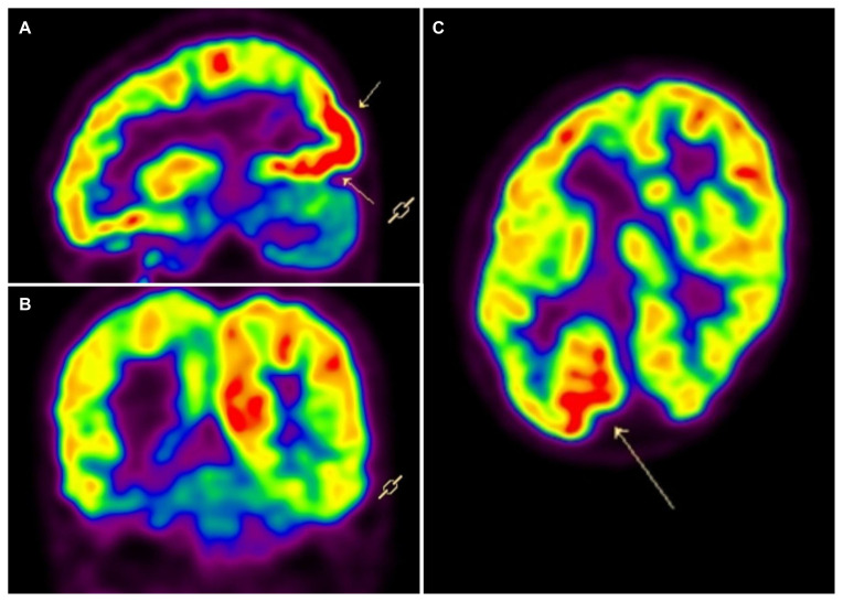 Pharmacoresistant Abdominal Seizures in Symptomatic Localization-Related Epilepsy.