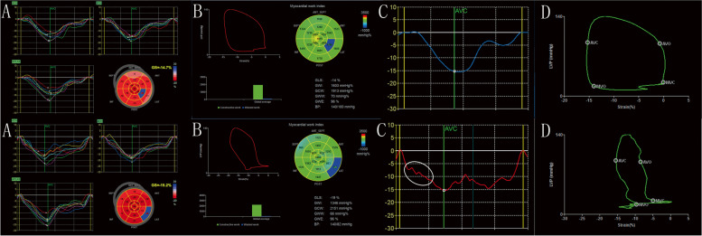 Afterload-related reference values for myocardial work indices.