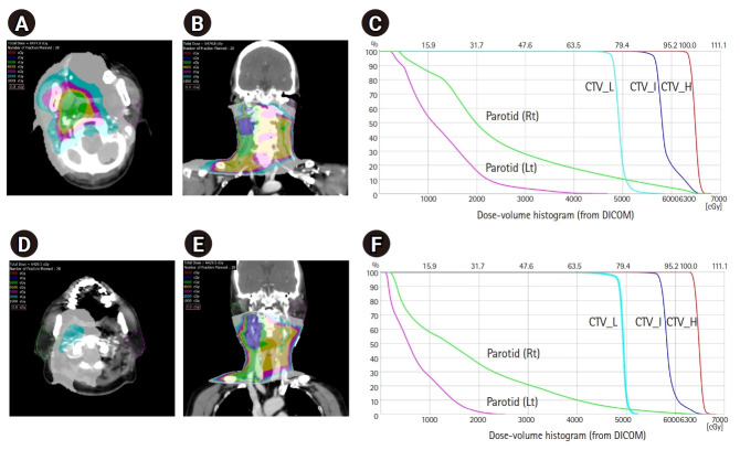 Retropharyngeal lymph node-sparing radiotherapy in patients with oropharyngeal carcinoma.