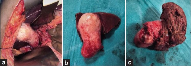 Demographic and clinicopathological Profile of Gall Bladder Cancer Patients: Study from a tertiary care center of the Sub-Himalayan region in Indo-Gangetic Belt.