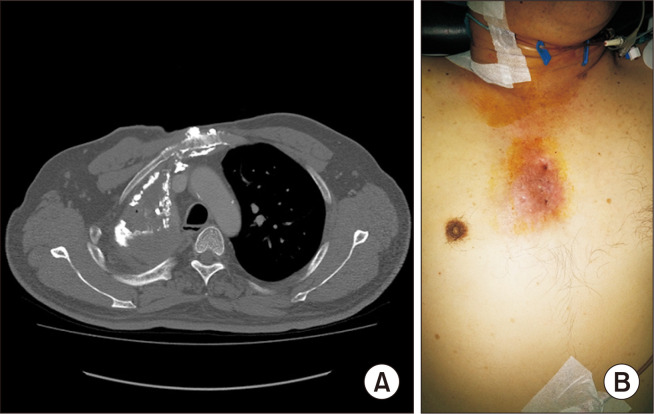 Thoracomyoplasty for Chronic Empyema and Osteoradionecrosis of the Chest Wall