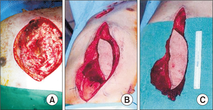 Thoracomyoplasty for Chronic Empyema and Osteoradionecrosis of the Chest Wall