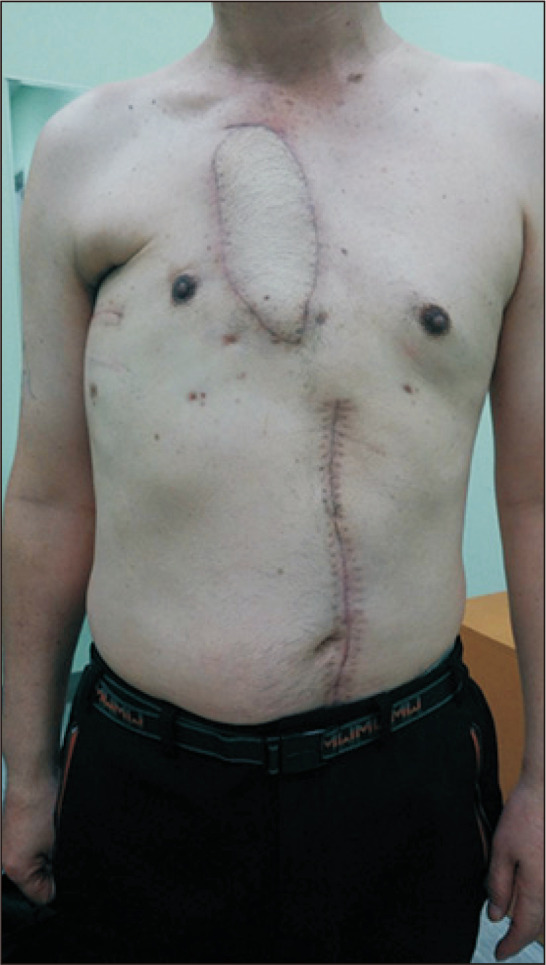 Thoracomyoplasty for Chronic Empyema and Osteoradionecrosis of the Chest Wall