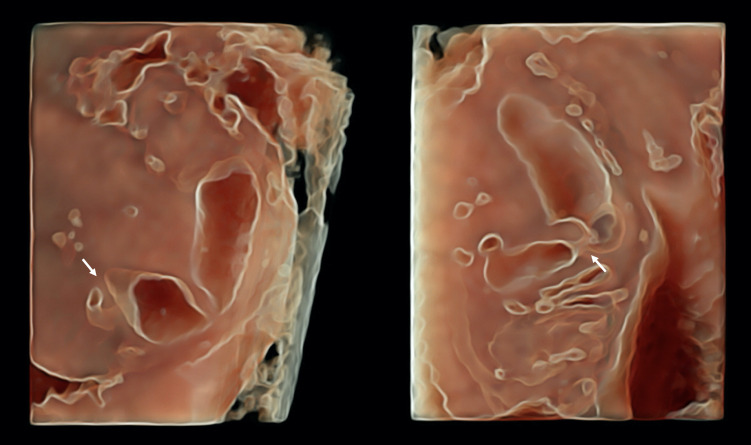 Antenatal diagnosis of jejunal atresia by 3D HDlive ultrasound: Case report and literature review