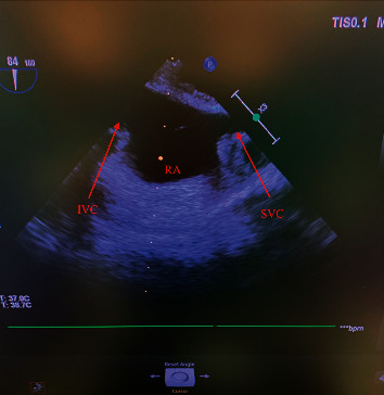 Intraoperative Transesophageal Echocardiography to Monitor for Pulmonary Emboli in a Pediatric Patient Undergoing Undifferentiated Embryonal Sarcoma of the Liver Resection.