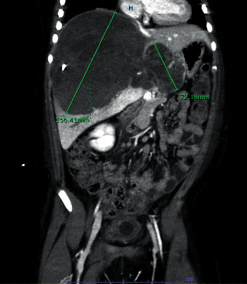 Intraoperative Transesophageal Echocardiography to Monitor for Pulmonary Emboli in a Pediatric Patient Undergoing Undifferentiated Embryonal Sarcoma of the Liver Resection.