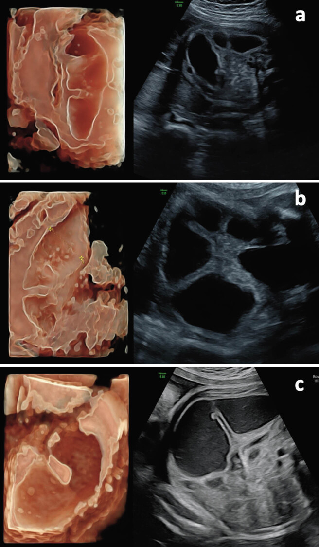 Antenatal diagnosis of jejunal atresia by 3D HDlive ultrasound: Case report and literature review