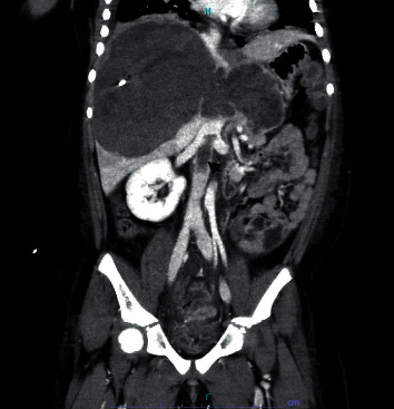 Intraoperative Transesophageal Echocardiography to Monitor for Pulmonary Emboli in a Pediatric Patient Undergoing Undifferentiated Embryonal Sarcoma of the Liver Resection.