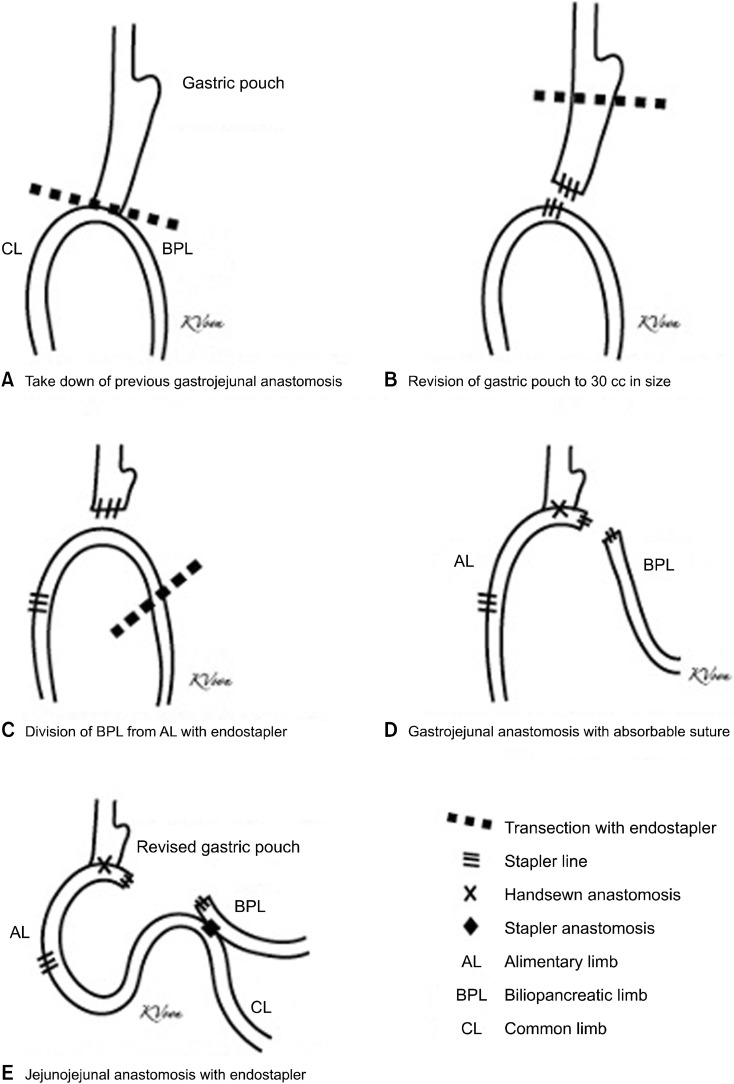 Conversion of One-Anastomosis Gastric Bypass (OAGB) to Roux-en-Y Gastric Bypass (RYGB) is Effective in Dealing with Late Complications of OAGB: Experience from a Tertiary Bariatric Center and Literature Review.