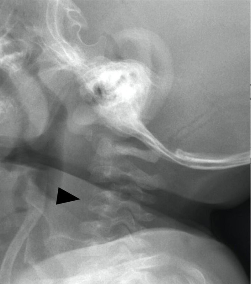 Cervical Spondylodiscitis in an Infant with Torticollis.