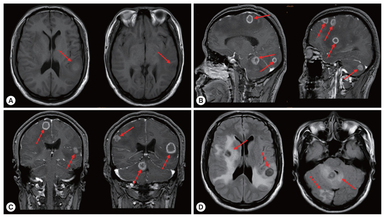 A Case of Human Hepatic Alveolar Echinococcosis Accompanied by Lung and Brain Metastases.