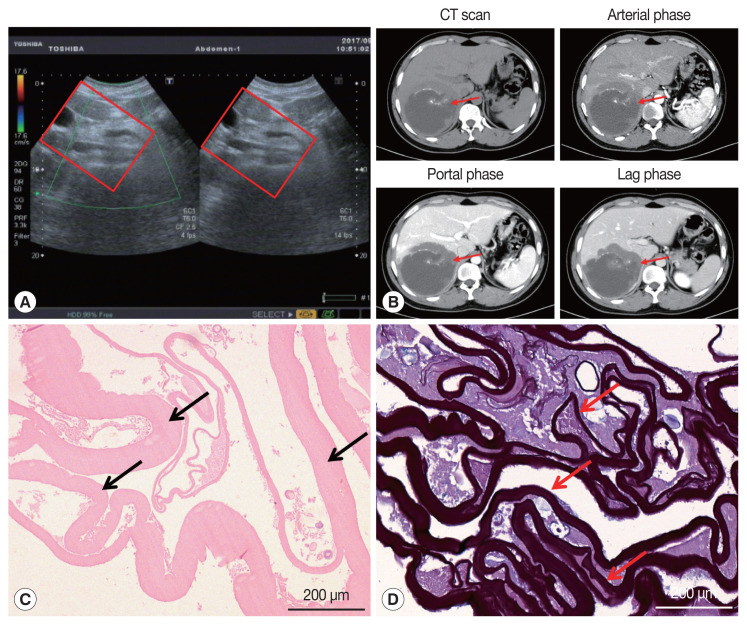 A Case of Human Hepatic Alveolar Echinococcosis Accompanied by Lung and Brain Metastases.