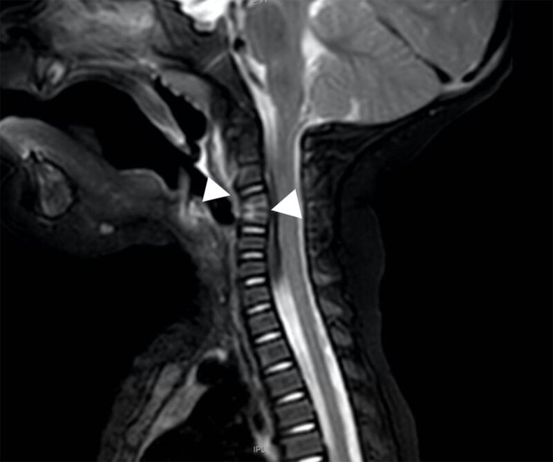 Cervical Spondylodiscitis in an Infant with Torticollis.