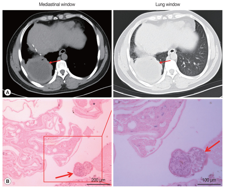 A Case of Human Hepatic Alveolar Echinococcosis Accompanied by Lung and Brain Metastases.