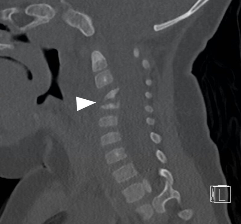 Cervical Spondylodiscitis in an Infant with Torticollis.