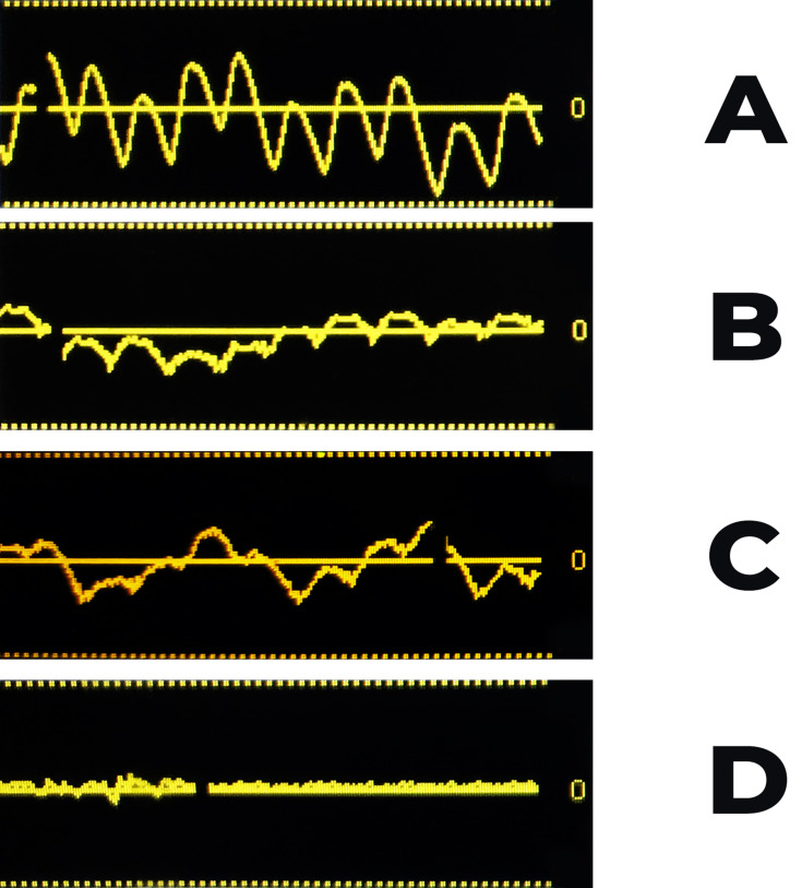 Analysis of Epidural Waveform to Determine Correct Epidural Catheter Placement After CSE Labor Analgesia.