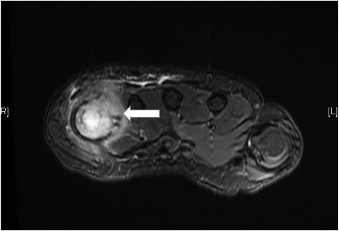 Sternal and metacarpal masses as the initial presentation of tuberculosis in a child