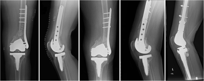 Immediate weight-bearing is safe following lateral locked plate fixation of periprosthetic distal femoral fractures.