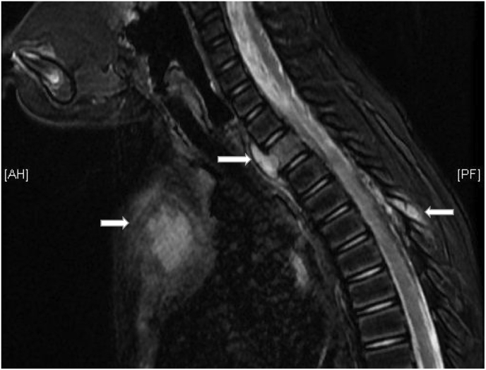 Sternal and metacarpal masses as the initial presentation of tuberculosis in a child