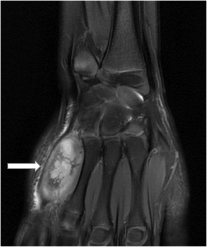 Sternal and metacarpal masses as the initial presentation of tuberculosis in a child