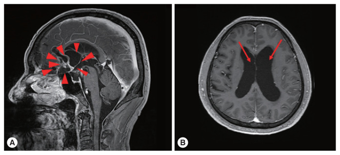 Infectious Causes of Eosinophilic Meningitis in Korean Patients: A Single-Institution Retrospective Chart Review from 2004 to 2018.