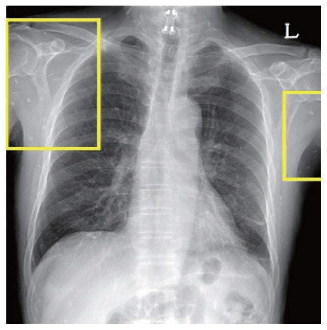 Infectious Causes of Eosinophilic Meningitis in Korean Patients: A Single-Institution Retrospective Chart Review from 2004 to 2018.