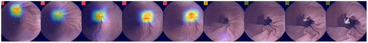 Artificial intelligence for the detection of polyps or cancer with colon capsule endoscopy.