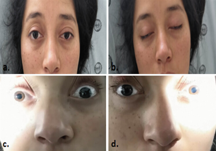 Miller Fisher syndrome treated with plasmapheresis during pregnancy: Case report and review of the literature