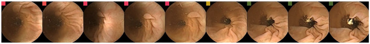 Artificial intelligence for the detection of polyps or cancer with colon capsule endoscopy.