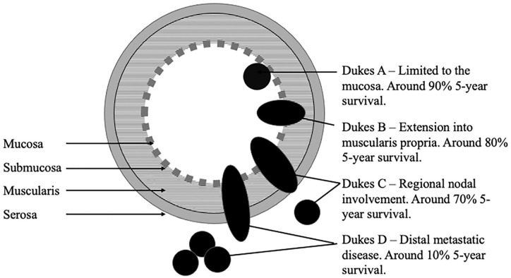 Artificial intelligence for the detection of polyps or cancer with colon capsule endoscopy.