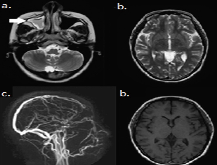 Miller Fisher syndrome treated with plasmapheresis during pregnancy: Case report and review of the literature