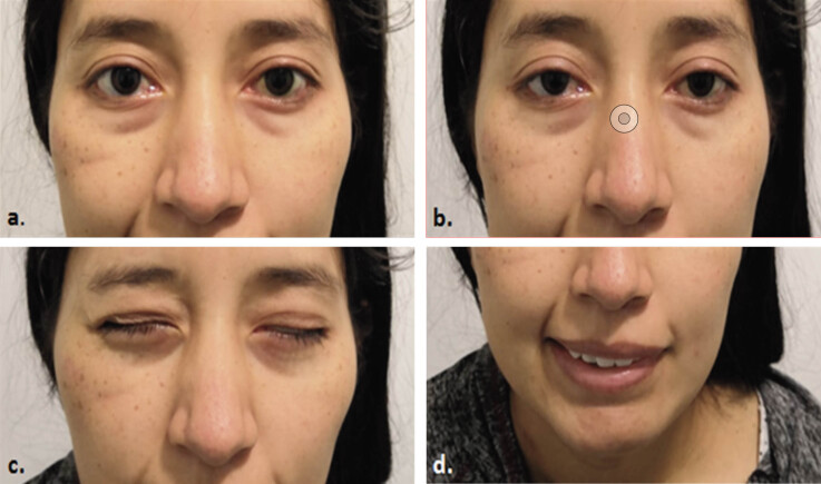 Miller Fisher syndrome treated with plasmapheresis during pregnancy: Case report and review of the literature