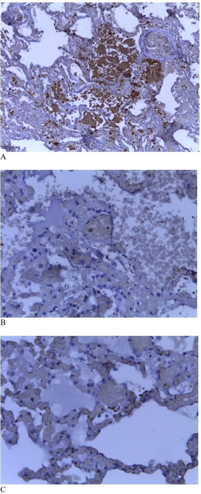 Full autopsy in a confirmed COVID-19 patient in Lagos, Nigeria – A case report