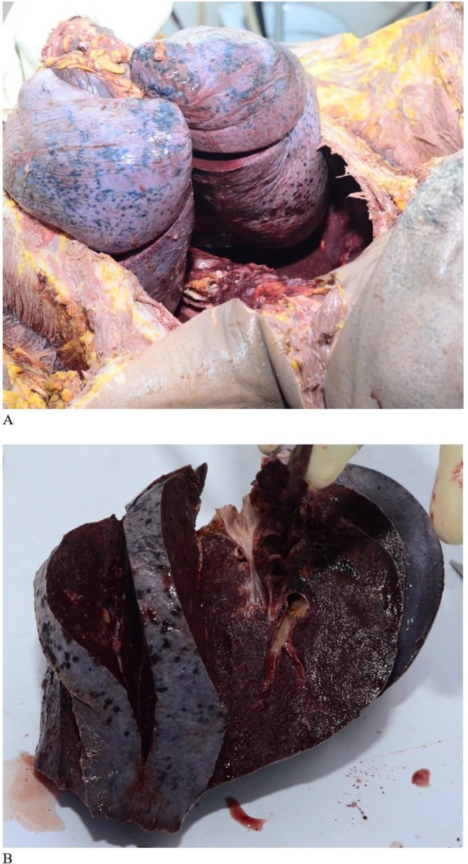 Full autopsy in a confirmed COVID-19 patient in Lagos, Nigeria – A case report