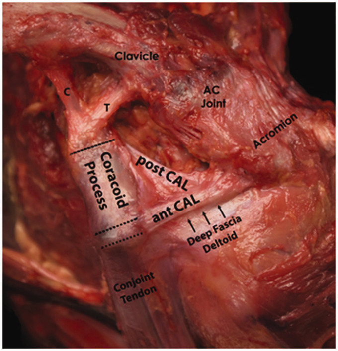 Does Preservation of Coracoacromial Ligament Reduce the Acromial Stress Pathology Following Reverse Total Shoulder Arthroplasty?