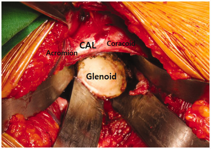 Does Preservation of Coracoacromial Ligament Reduce the Acromial Stress Pathology Following Reverse Total Shoulder Arthroplasty?