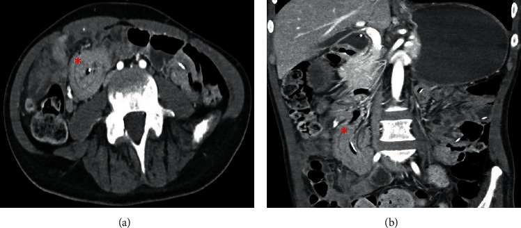 Adult Intestinal Intussusception Caused by the Gastrojejunostomy Tube: An Endoscopically Treatable Phenomenon.