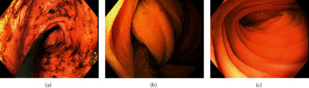 Adult Intestinal Intussusception Caused by the Gastrojejunostomy Tube: An Endoscopically Treatable Phenomenon.