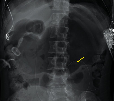 Adult Intestinal Intussusception Caused by the Gastrojejunostomy Tube: An Endoscopically Treatable Phenomenon.