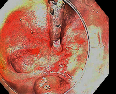 Massive Hematochezia from a Large Bleeding Duodenal Diverticulum.