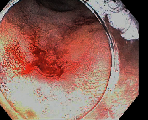 Massive Hematochezia from a Large Bleeding Duodenal Diverticulum.