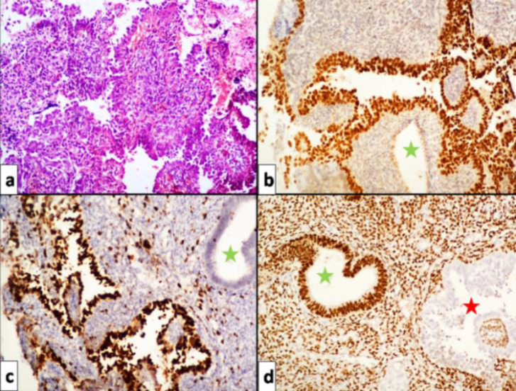 Endometrial Serous Carcinoma Arising From Adenomyosis: A Clinico-Pathological Insight.