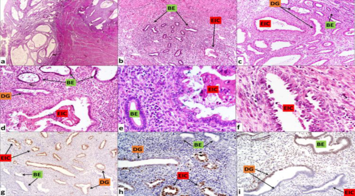 Endometrial Serous Carcinoma Arising From Adenomyosis: A Clinico-Pathological Insight.