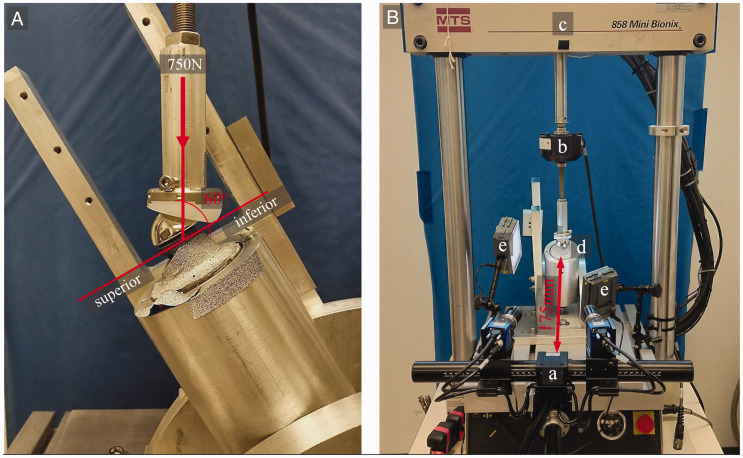 Reverse Total Shoulder Arthroplasty Baseplate Stability in Superior Bone Loss With Augmented Implant.